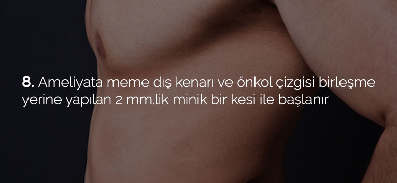 jinekomasti_08