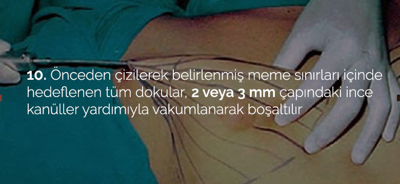 jinekomasti_10