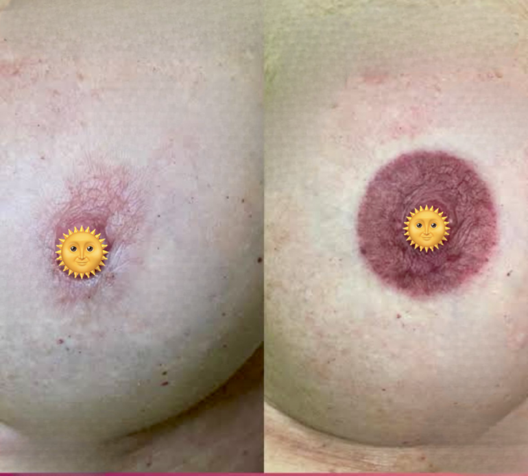 areola
