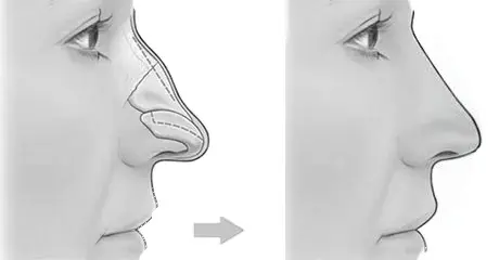 rinoplastide zor ameliyat kolay ameliyat farkı